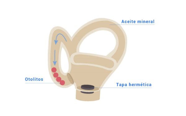 Semicircular canal with moving otholits small size (Left side)