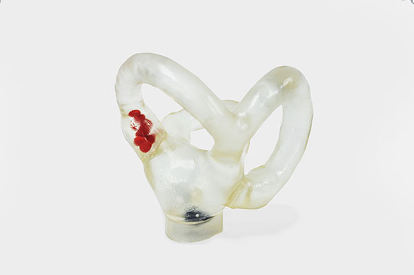 Semicircular canal with moving otholits big size (Right side)