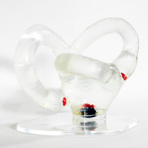 Semicircular canal with moving otholits big size (Right side)