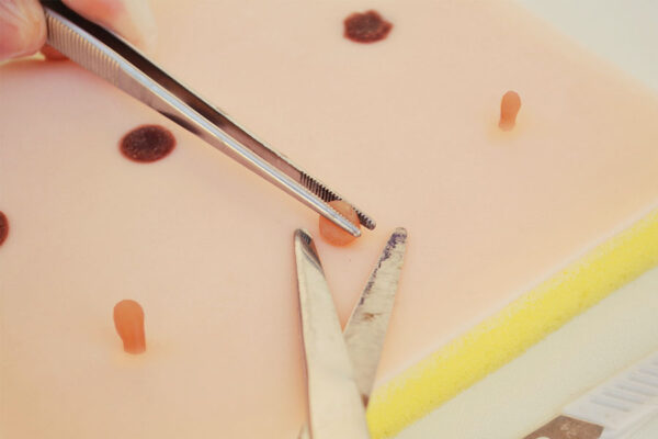 Fibroids and moles skin pad