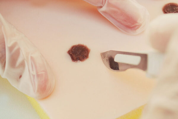 Fibroids and moles skin pad