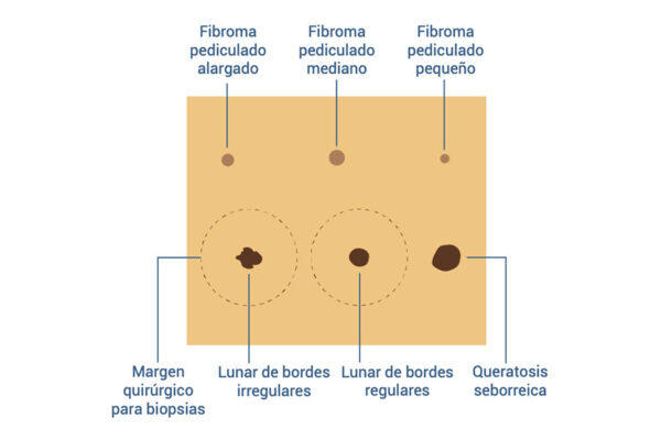 Fibroids and moles skin pad
