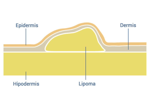 1 Cyst + 1 Lipoma skin pad