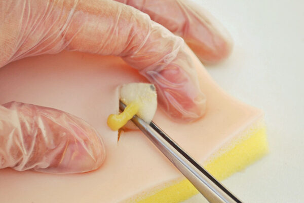 Sebaceous cyst skin pad