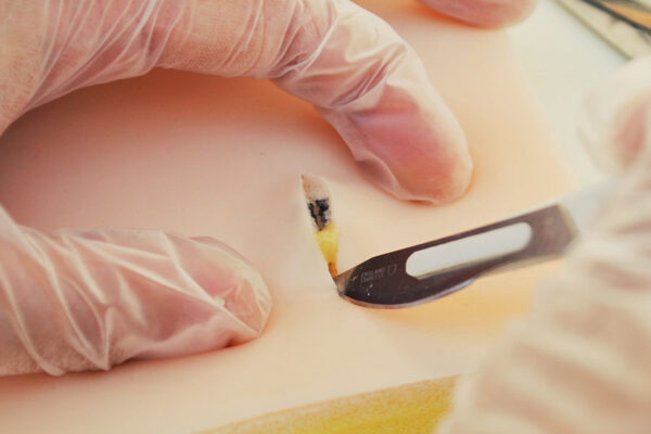 Sebaceous cyst skin pad