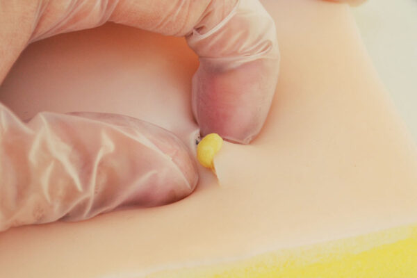 Sebaceous cyst skin pad