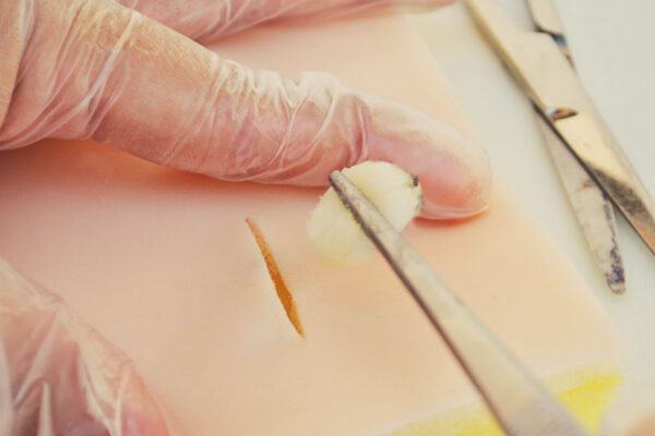 Sebaceous cyst skin pad