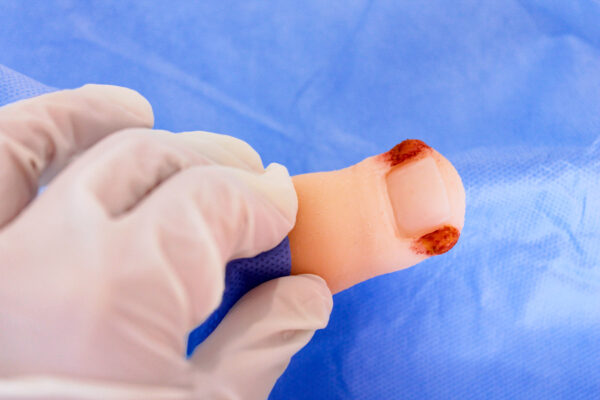 Onychocryptosis simulator