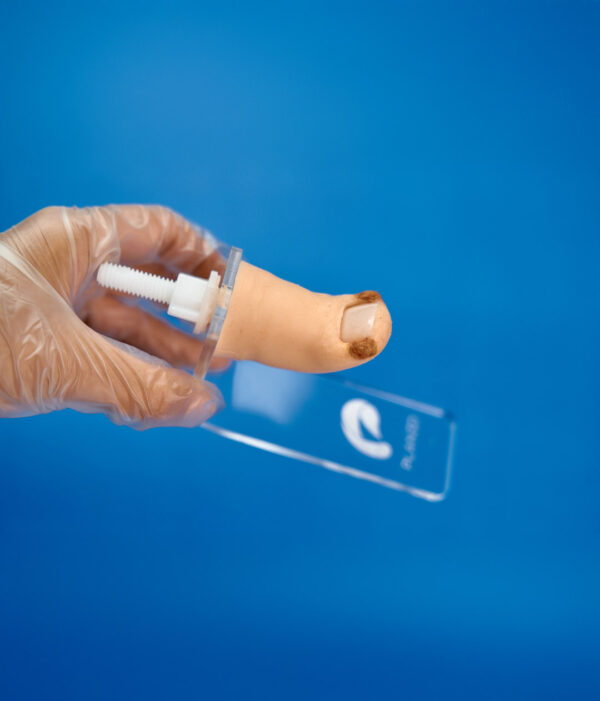 Onychocryptosis Replacement