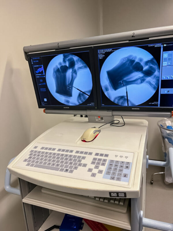 Foot with hallux valgus, radiopaque bones