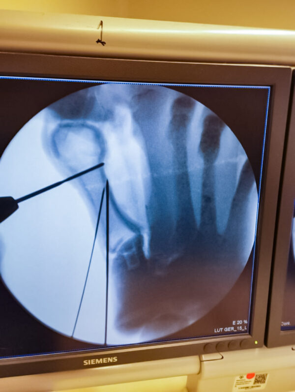 Foot with hallux valgus, radiopaque bones
