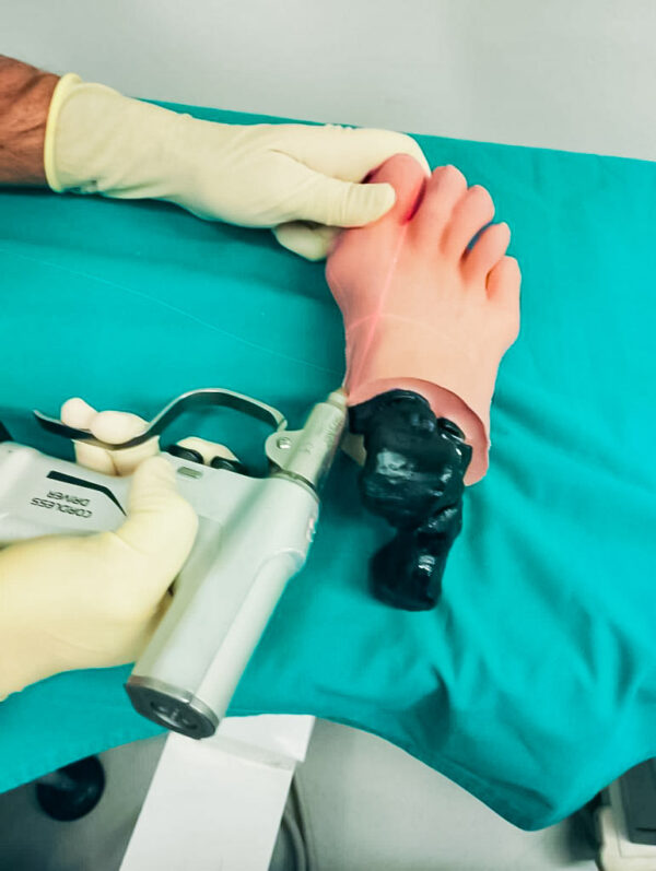 Foot with hallux valgus, radiopaque bones