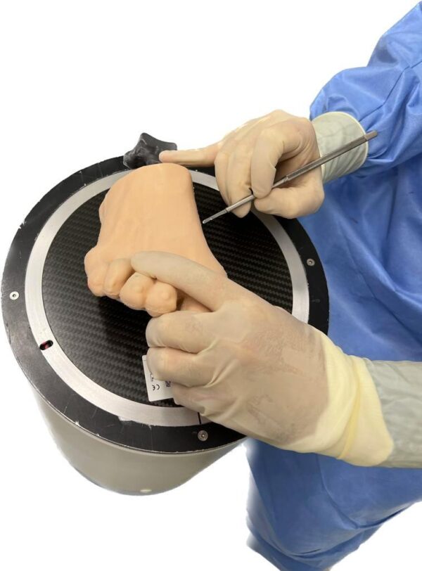 Foot with hallux valgus, radiopaque bones