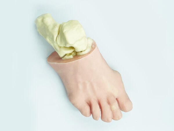 Foot with hallux valgus, radiopaque bones
