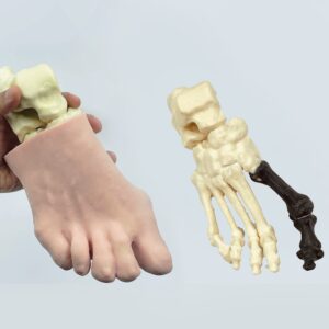 Foot with hallux valgus, radiopaque bones