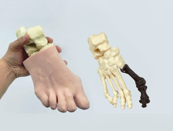 Foot with hallux valgus, radiopaque bones