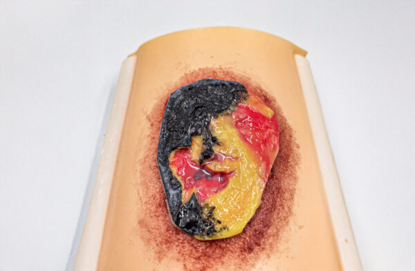 advancedulcer_01 The advanced pressure ulcer skin pad