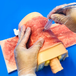 skin_burn 02 Skin burn due to radiotherapy