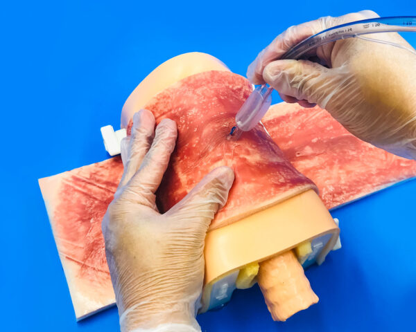 Skin burn due to radiotherapy